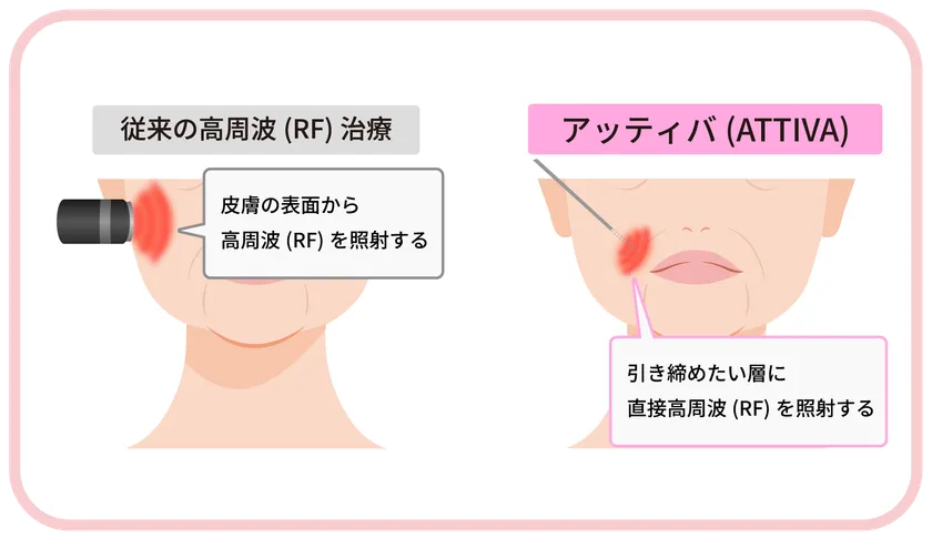 従来の高周波とATTIVA(アッティバ)の違い