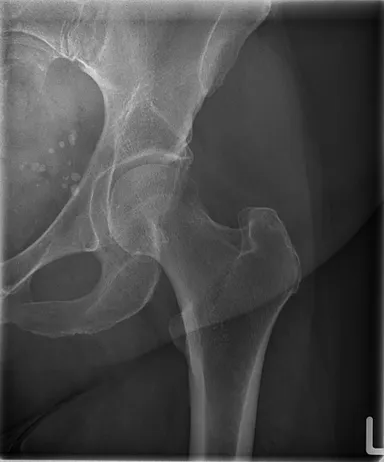 TRB 9020Hで撮影した大腿骨レントゲン写真