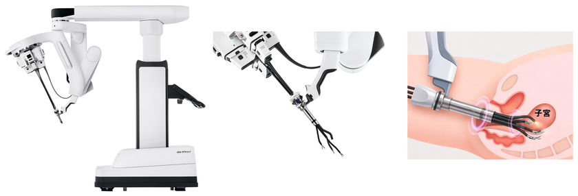 大阪初!関西メディカル病院、
最新鋭ロボットを用いたvNOTES子宮全摘術開始