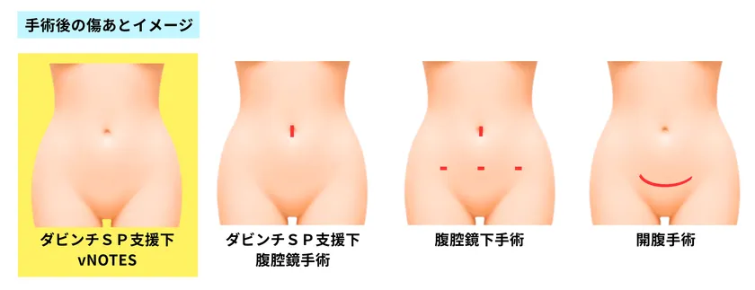 従来手術と比較した創部イメージ(vNOTESでは腹部に傷が残らない)