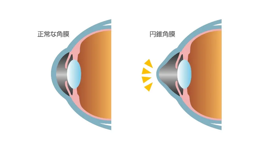 円錐角膜とはどんな病気？