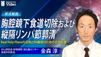 胸腔鏡下食道切除および縦隔リンパ節郭清