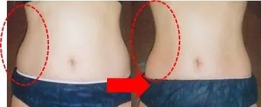 症例写真(お腹)