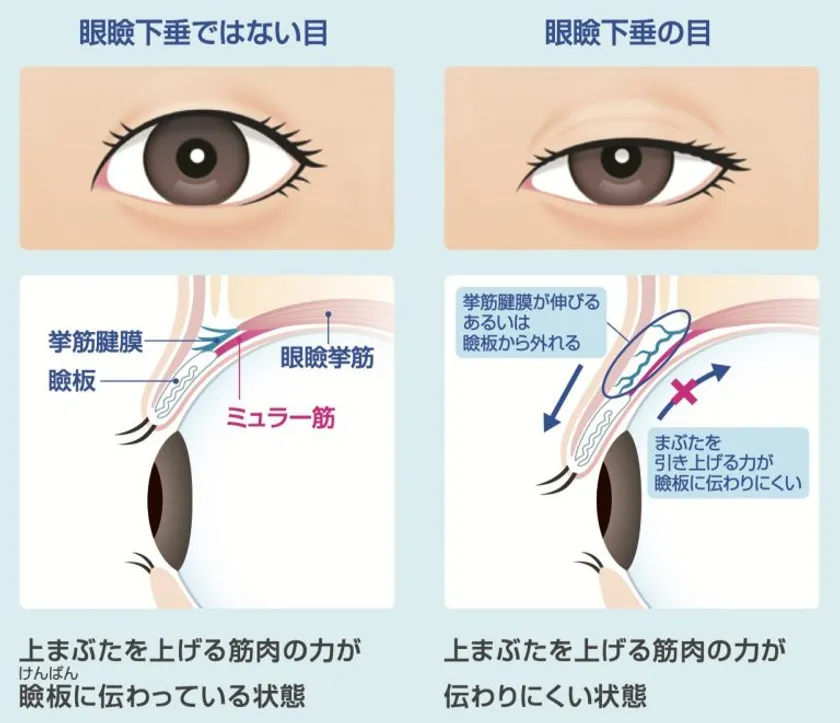 眼瞼下垂とは