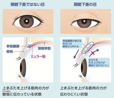 眼瞼下垂とは