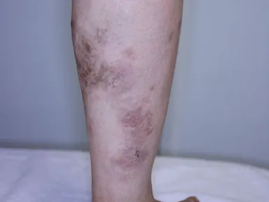 レッグベイン症例(1)[治療前]