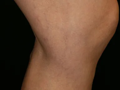 レッグベイン症例(2)[治療後]