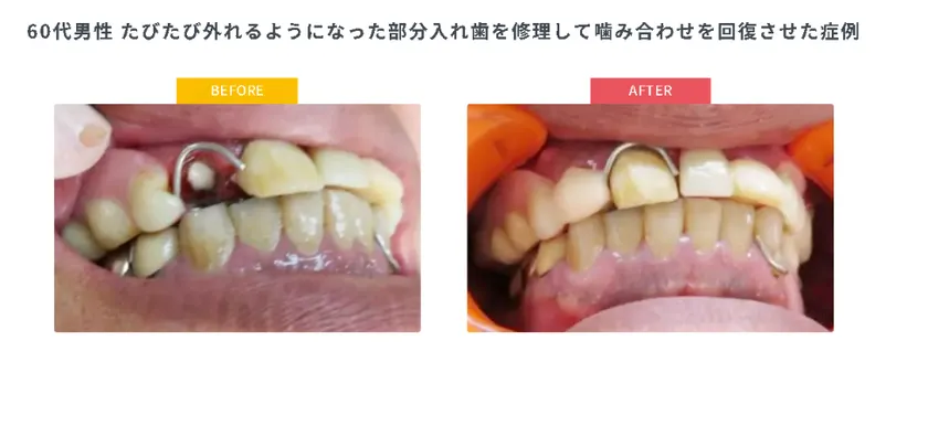 入れ歯を修理して噛み合わせを回復させた症例