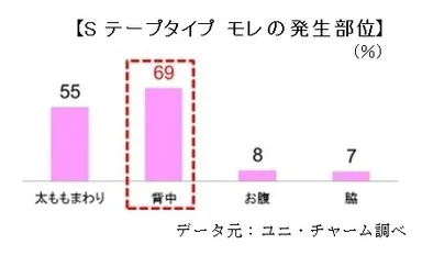 Sテープタイプ モレの発生部位
