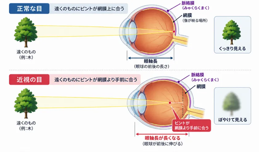 正常な目と近視の目