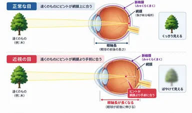 正常な目と近視の目