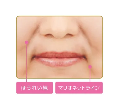 ほうれい線とマリオネットライン