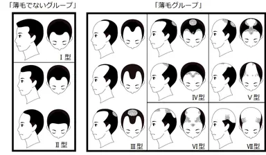 【図1】薄毛度合いの分類