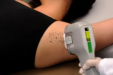 miraDry(R) イメージ1