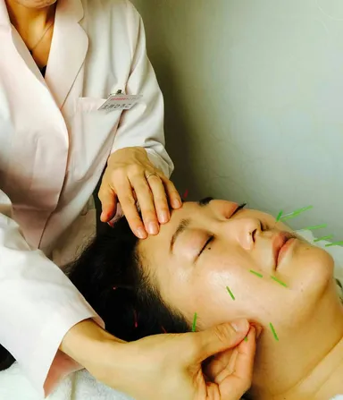ステンレス鍼を刺す「美容鍼」