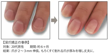 深爪矯正の事例