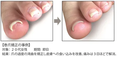巻爪矯正の事例
