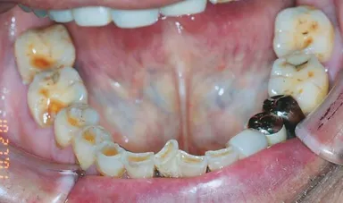 咬耗(こうもう)