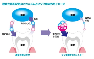 脱灰と再石灰化のメカニズムとフッ化物の作用イメージ