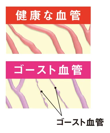 健康な血管とゴースト血管