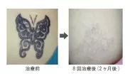 画像6：タトゥー除去の症例写真