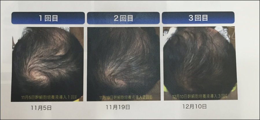 薄毛治療から育毛エステの時代へ 頭皮若返り わずか１ヶ月で髪の毛フサフサ 株式会社 シャンテリーのプレスリリース