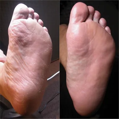 足裏角質除去の結果